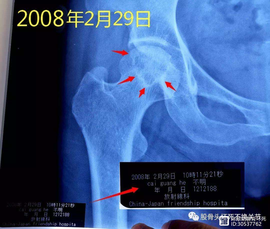 沧州人工骨头医保报销多少(人工骨头医保报销多少比例)